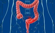 Proctologia Senza Dolore - Immagine 1